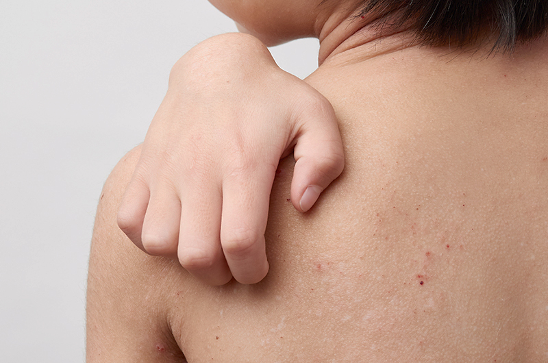 かゆみ・蕁麻疹・水虫などでお困りではありませんか？